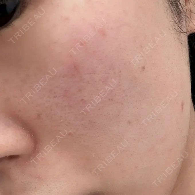 エレクトロポレーション / ピーリング（ハリ・ツヤ） / ルメッカ Otus Clinic 【オータスクリニック】 DAY 0 メイン用