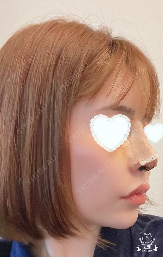 隆鼻術 / 鼻尖形成（切開） / 鼻中隔延長（切開） / 軟骨移植 / 鼻修正 LOCHIC CLINIC GINZA【ロシッククリニック銀座】 DAY 5 メイン用