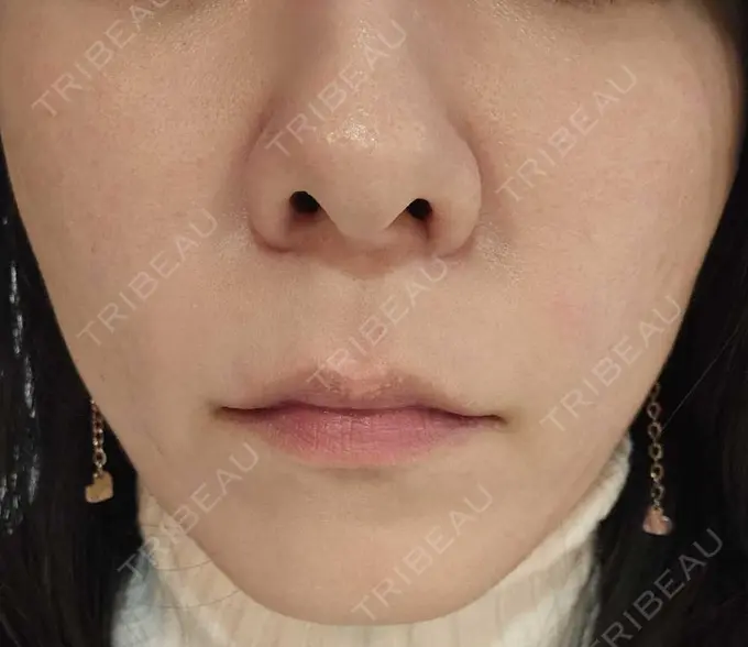 その他（肌） 湘南美容クリニック 仙台院 AFTER メイン用