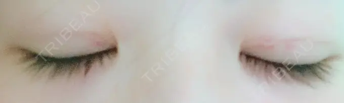 二重埋没 湘南美容クリニック 京都院 DAY 7 メイン用