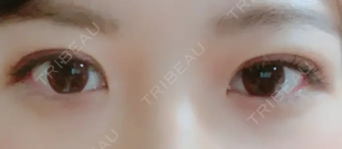 二重埋没 湘南美容クリニック 京都院 DAY 7 メイン用