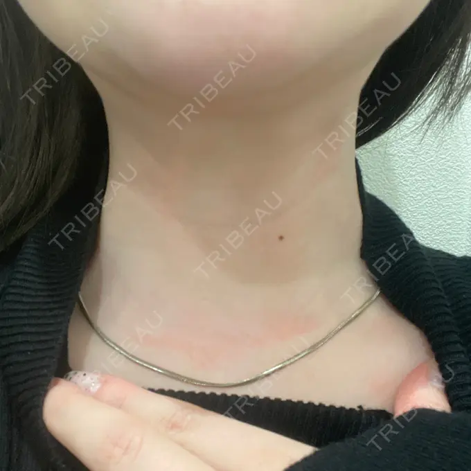 ガミースマイル手術 / ボトックス（エラ・小顔） / ボトックス（首） 東京シンデレラ美容外科 大宮院 AFTER メイン用