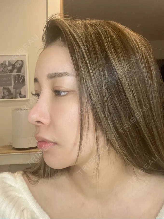 額を丸く / 脂肪注入（額） / 脂肪注入（目の下） ルーチェクリニック 銀座院 DAY 36 メイン用