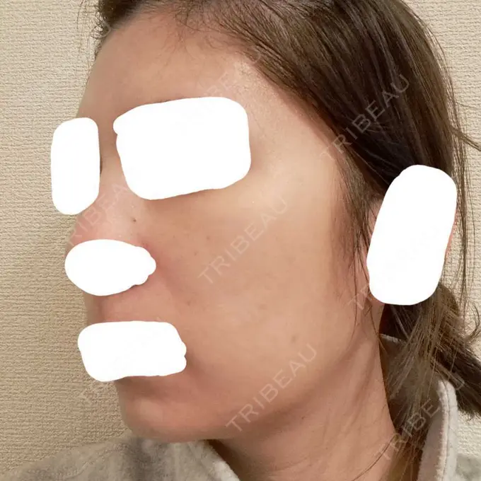 ヴェルヴェットスキン ブリリアスキンクリニック DAY 4 メイン用