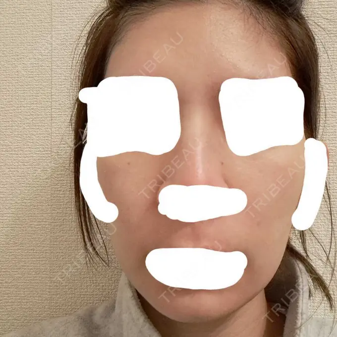 ヴェルヴェットスキン ブリリアスキンクリニック DAY 4 メイン用