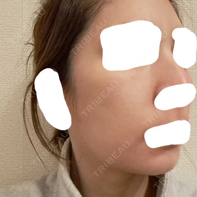 ヴェルヴェットスキン ブリリアスキンクリニック DAY 4 メイン用