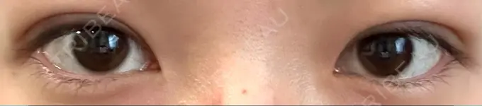 二重埋没 湘南美容クリニック 京都院 DAY 5 メイン用