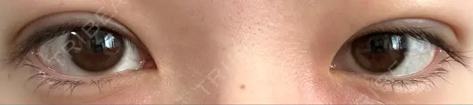 二重埋没 湘南美容クリニック 京都院 DAY 7 メイン用