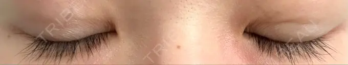 二重埋没 湘南美容クリニック 京都院 DAY 7 メイン用