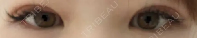 二重埋没 OMI CLINIC 【オミクリニック】 DAY 5 メイン用