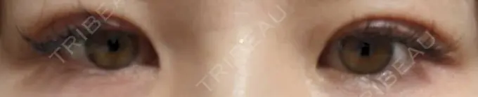 二重埋没 OMI CLINIC 【オミクリニック】 DAY 6 メイン用