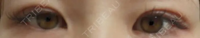 二重埋没 OMI CLINIC 【オミクリニック】 DAY 7 メイン用