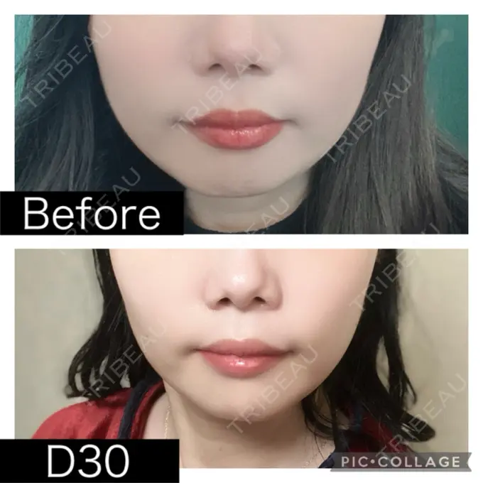 脂肪溶解注射（顔） SK新宿歌舞伎町美容外科・歯科 AFTER メイン用