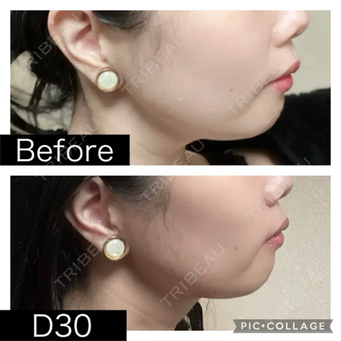 脂肪溶解注射（顔） SK新宿歌舞伎町美容外科・歯科 DAY 30 メイン用