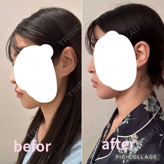 糸リフト / 脂肪吸引（顔） / ボトックス（エラ・小顔） RIVER CLINIC（リバークリニック） DAY 18 メイン用