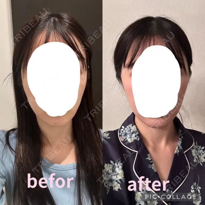 糸リフト / 脂肪吸引（顔） / ボトックス（エラ・小顔） RIVER CLINIC（リバークリニック） DAY 18 メイン用