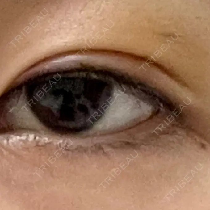 アートメイク（アイライン） 筋肉・美容クリニック DAY 0 メイン用