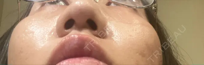 鼻尖形成（切開） / 鼻中隔延長（非切開） ASTRA BEAUTY CLINIC DAY 26 メイン用