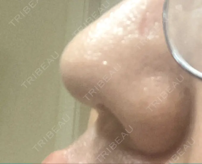 鼻尖形成（切開） / 鼻中隔延長（非切開） ASTRA BEAUTY CLINIC DAY 26 メイン用