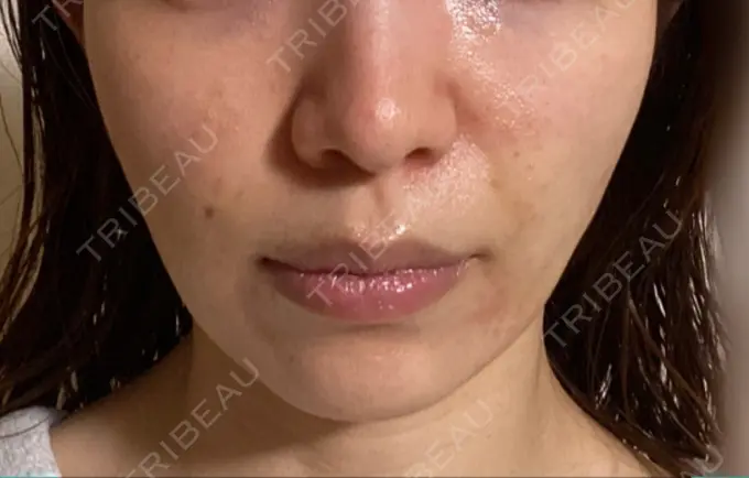 その他（肌） Rosa Beauty Clinic DAY 9 メイン用