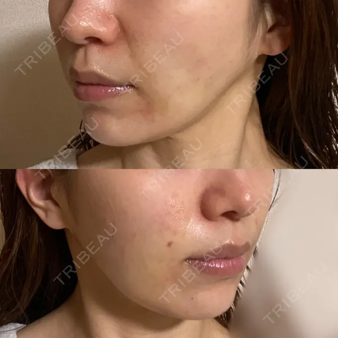 その他（肌） Rosa Beauty Clinic DAY 9 メイン用