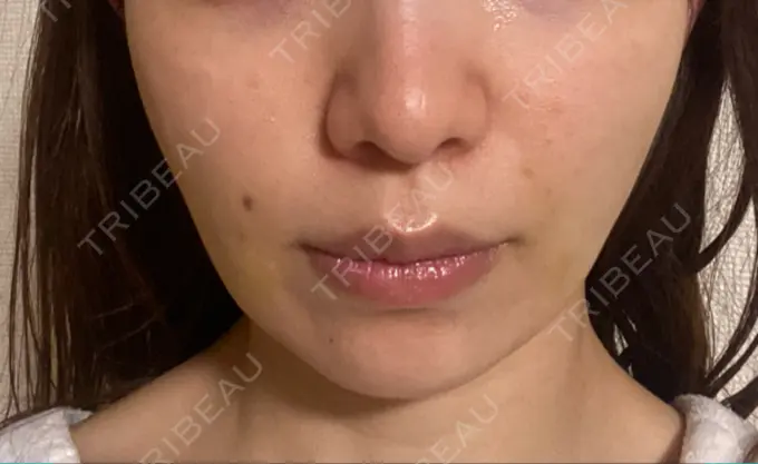 その他（肌） Rosa Beauty Clinic DAY 7 メイン用