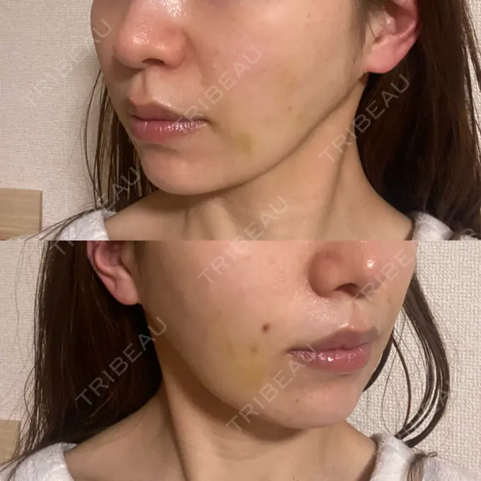 その他（肌） Rosa Beauty Clinic DAY 7 メイン用