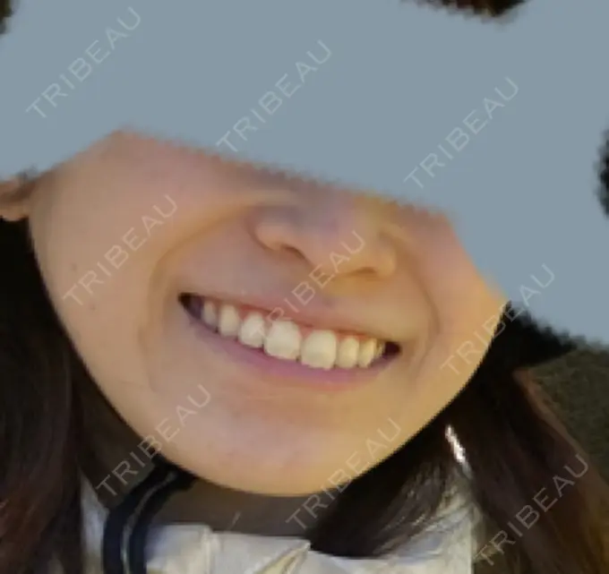 ピコレーザートーニング（美白・肝斑） SIGNATURE CLINIC 銀座 DAY 8 メイン用