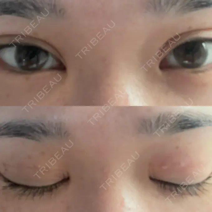 二重埋没 / 上まぶたの脂肪取り TCB東京中央美容外科 六本木院 DAY 5 メイン用