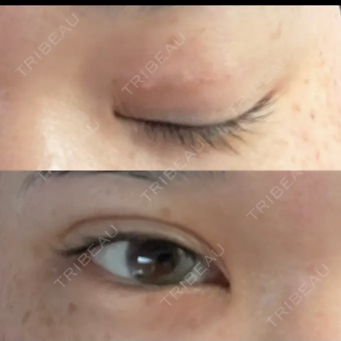 二重埋没 / 上まぶたの脂肪取り TCB東京中央美容外科 六本木院 DAY 6 メイン用