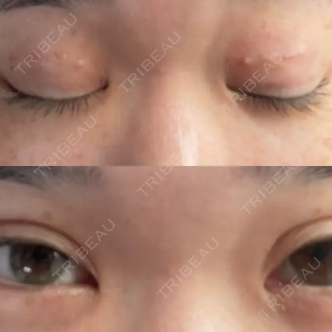 二重埋没 / 上まぶたの脂肪取り TCB東京中央美容外科 六本木院 DAY 7 メイン用