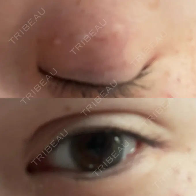 二重埋没 / 上まぶたの脂肪取り TCB東京中央美容外科 六本木院 DAY 8 メイン用