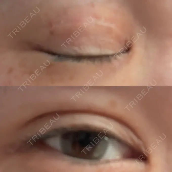 二重埋没 / 上まぶたの脂肪取り TCB東京中央美容外科 六本木院 DAY 9 メイン用