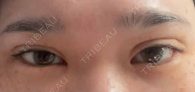 二重埋没 / 上まぶたの脂肪取り TCB東京中央美容外科 六本木院 DAY 11 メイン用