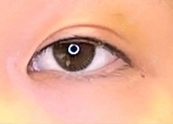 アートメイク（アイライン） 筋肉・美容クリニック DAY 1 メイン用