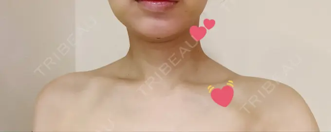 ボトックス（肩） 日本ウェルネス再生クリニック DAY 5 メイン用