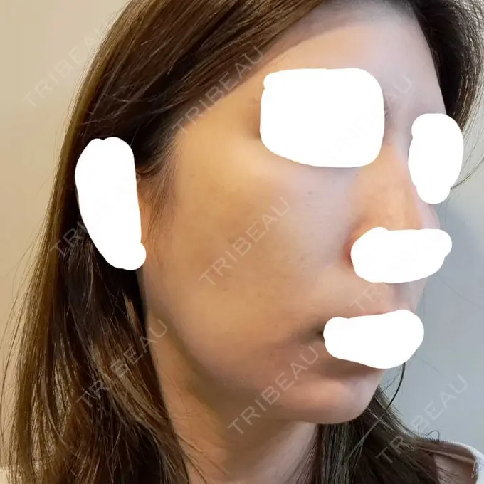 ヴェルヴェットスキン ブリリアスキンクリニック DAY 7 メイン用