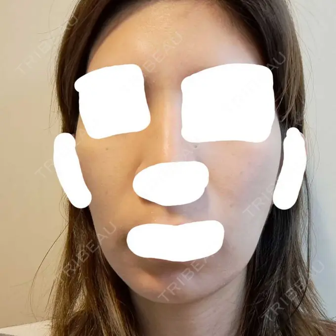 ヴェルヴェットスキン ブリリアスキンクリニック AFTER メイン用