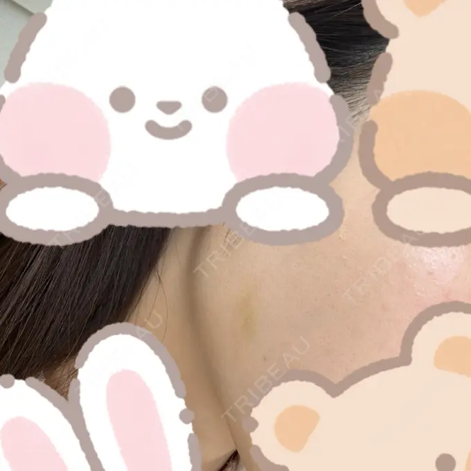 糸リフト / バッカルファット除去 RIVER CLINIC（リバークリニック） DAY 30 メイン用