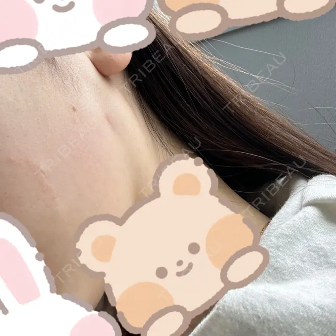 糸リフト / バッカルファット除去 RIVER CLINIC（リバークリニック） DAY 30 メイン用