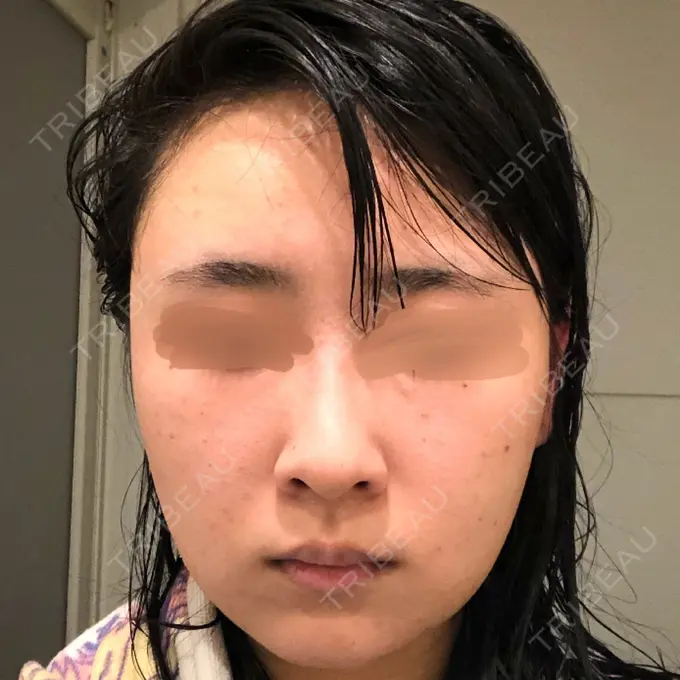 バッカルファット除去 / 脂肪吸引（顔） / ヒアルロン酸注入（鼻） / ボトックス（あご） / 水光注射（ハリ・美肌） / ボトックス（エラ・小顔） / ボトックス（口角） / 白玉点滴・注射 エートップ美容整形外科 DAY 5 メイン用