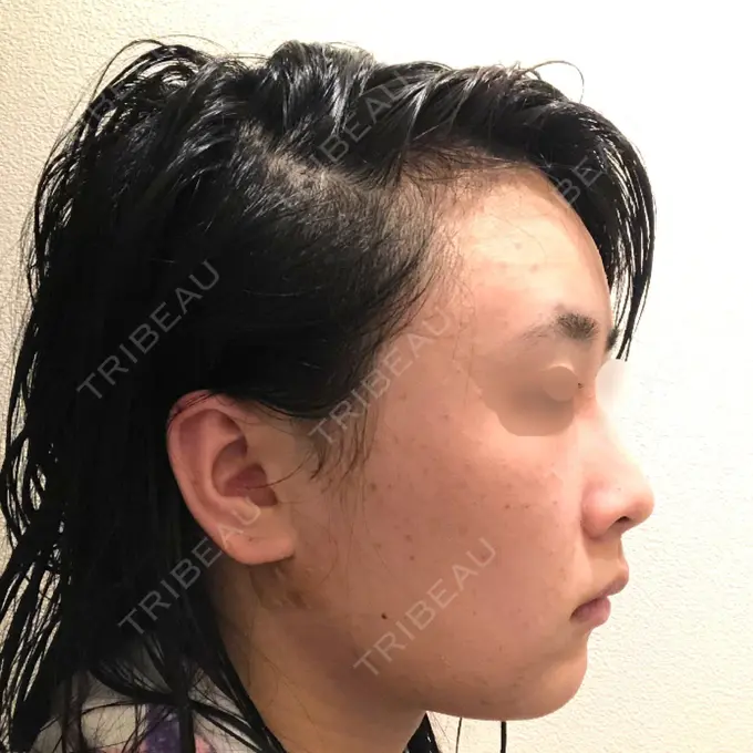 バッカルファット除去 / 脂肪吸引（顔） / ヒアルロン酸注入（鼻） / ボトックス（あご） / 水光注射（ハリ・美肌） / ボトックス（エラ・小顔） / ボトックス（口角） / 白玉点滴・注射 エートップ美容整形外科 DAY 5 メイン用