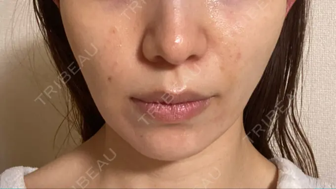 その他（肌） Rosa Beauty Clinic DAY 10 メイン用