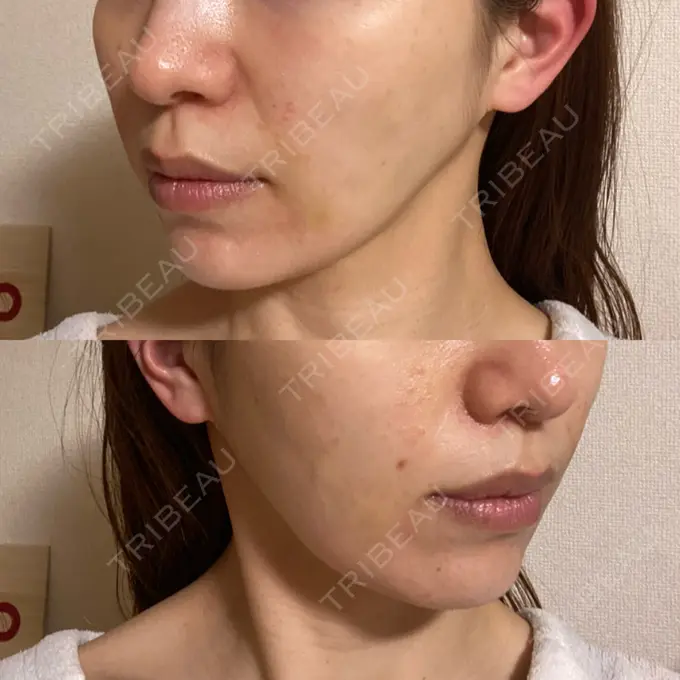 その他（肌） Rosa Beauty Clinic DAY 10 メイン用