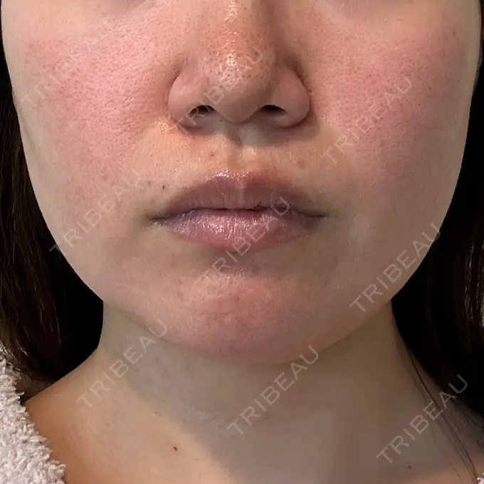 ボトックス（エラ・小顔） / ハイフ（顔） 川越TAクリニックアソシエ DAY 4 メイン用