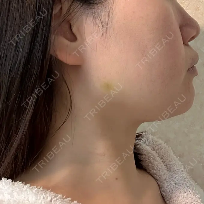 ボトックス（エラ・小顔） / ハイフ（顔） 川越TAクリニックアソシエ DAY 4 メイン用