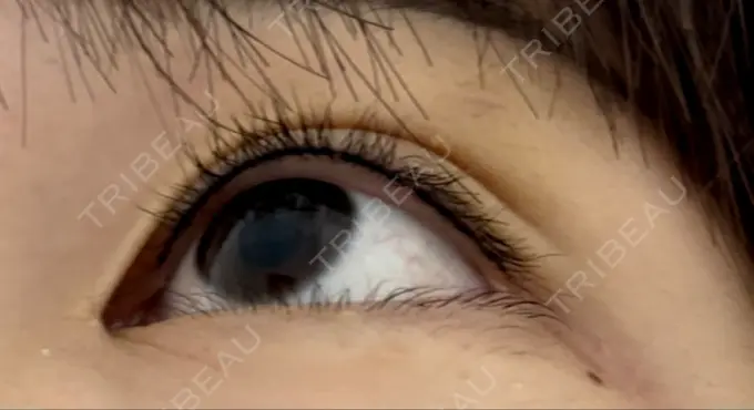 アートメイク（アイライン） 筋肉・美容クリニック DAY 3 メイン用