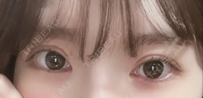 二重切開 / 上まぶたたるみ取り / 眼瞼下垂（非切開） WOM CLINIC GINZA （ワム クリニック ギンザ） AFTER メイン用