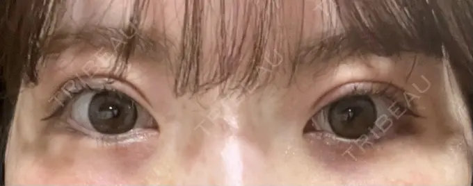 二重切開 / 上まぶたたるみ取り / 眼瞼下垂（非切開） WOM CLINIC GINZA （ワム クリニック ギンザ） DAY 15 メイン用