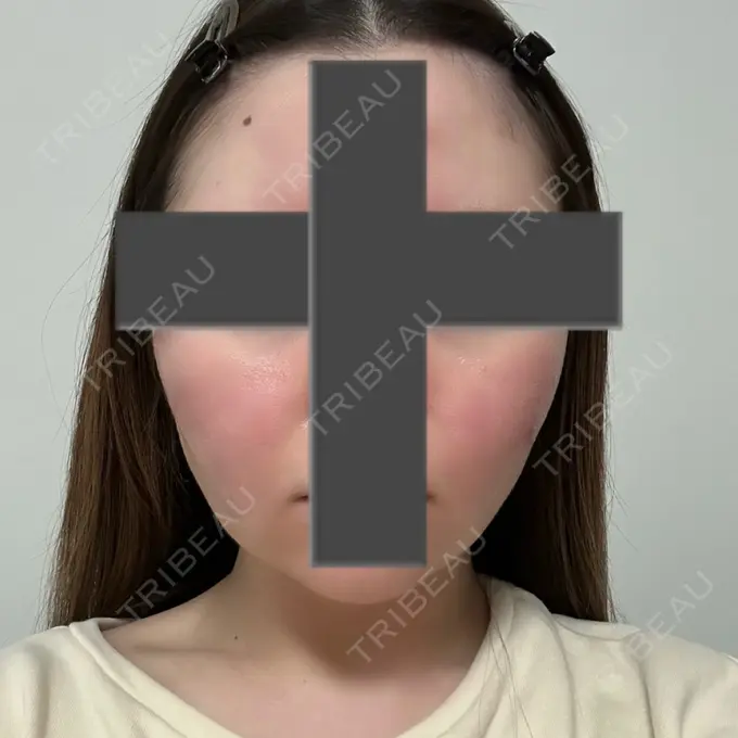 脂肪吸引（顔） / ジョールファット除去 / ヒアルロン酸注入（あご） / ボトックス（エラ・小顔） Otus Clinic 【オータスクリニック】 DAY 92 メイン用